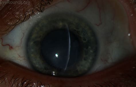 varicella zoster corneal involvement